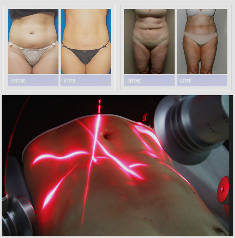 Non-invasive Professional 6d Lipolaser Slimming Machine 532nm Wavelength Green Light Red Light Cold Laserlipo For Body Contouring Fat Reduction Professional 532nm 635nm 6D Lipolaser Slimming Machine Lipolaser slimming machine,lipo laser machine for sale,lipolaser machine cost