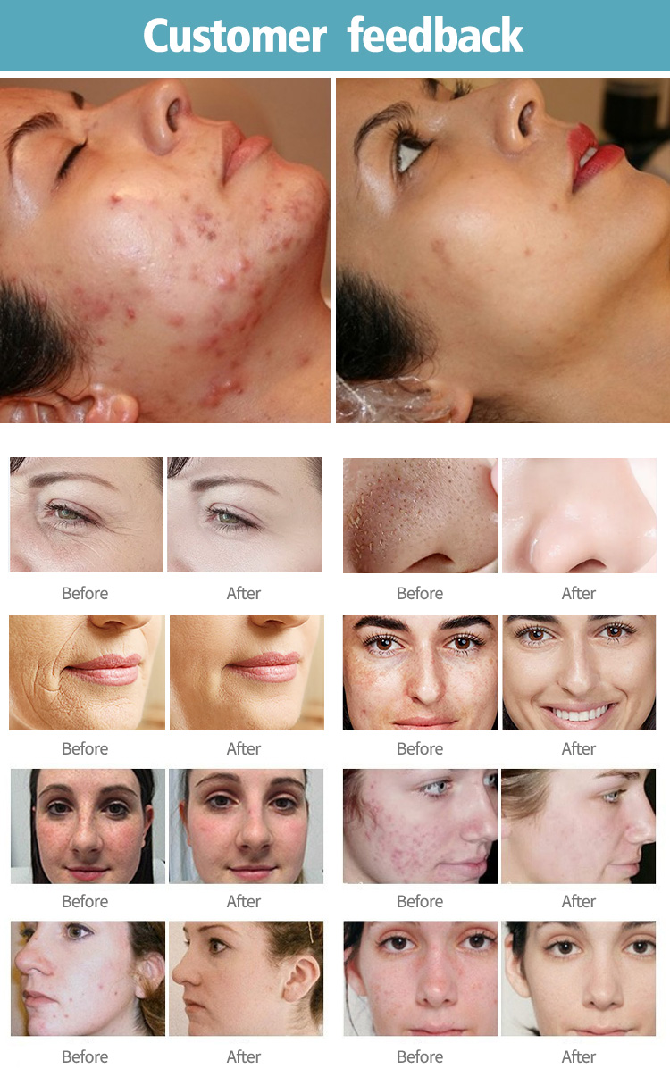 oem skin repair scar acne removal co2 fractional beauty salon fractionated co2 laser co2 fractional laser for vaginal treatment Skin repair scar acne removal co2 fractional laser machine - Honkay co2 laser,fractional laser machine,fractional co2,fractional co2 laser,co2 fractional laser machine