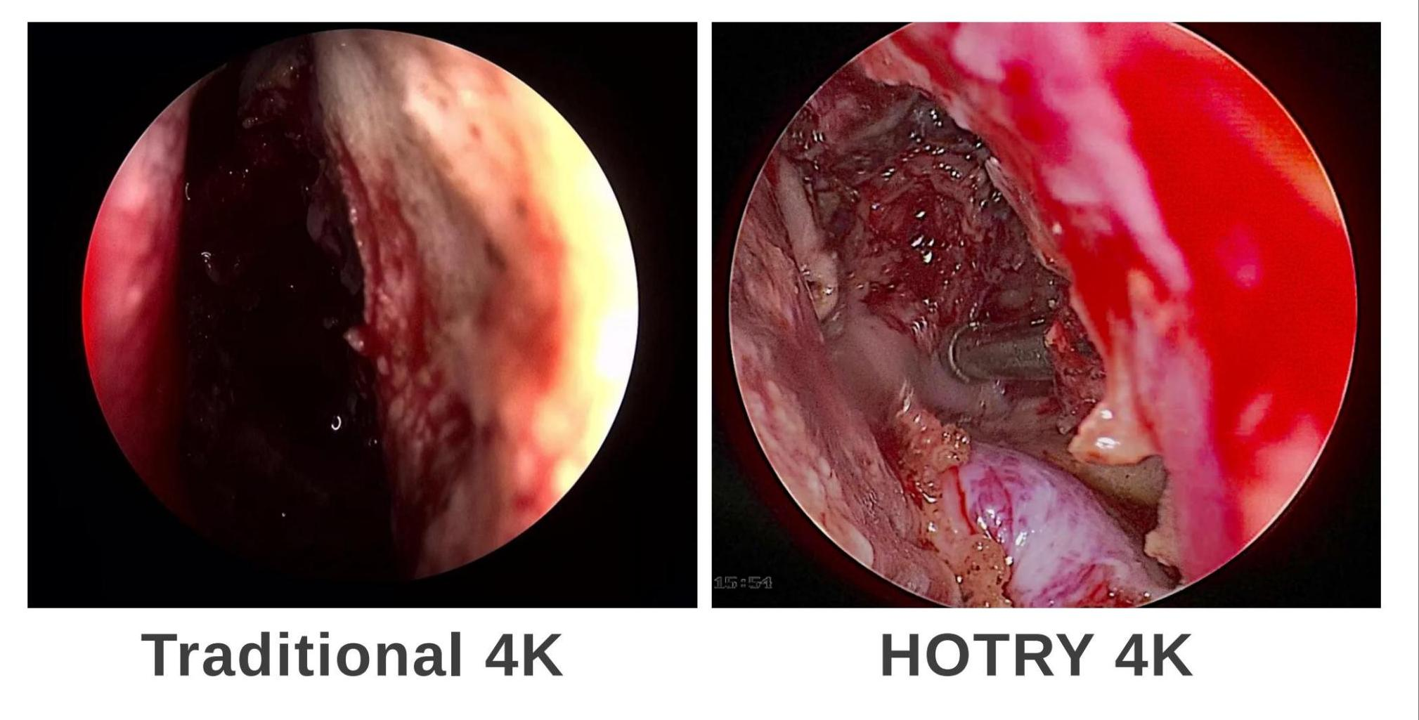 【Hotry 4k Neuroendoscopy System】 In neurosurgery, how should we choose an endoscopic device? Can endoscopic systems in other departments be competent for neurosurgery?