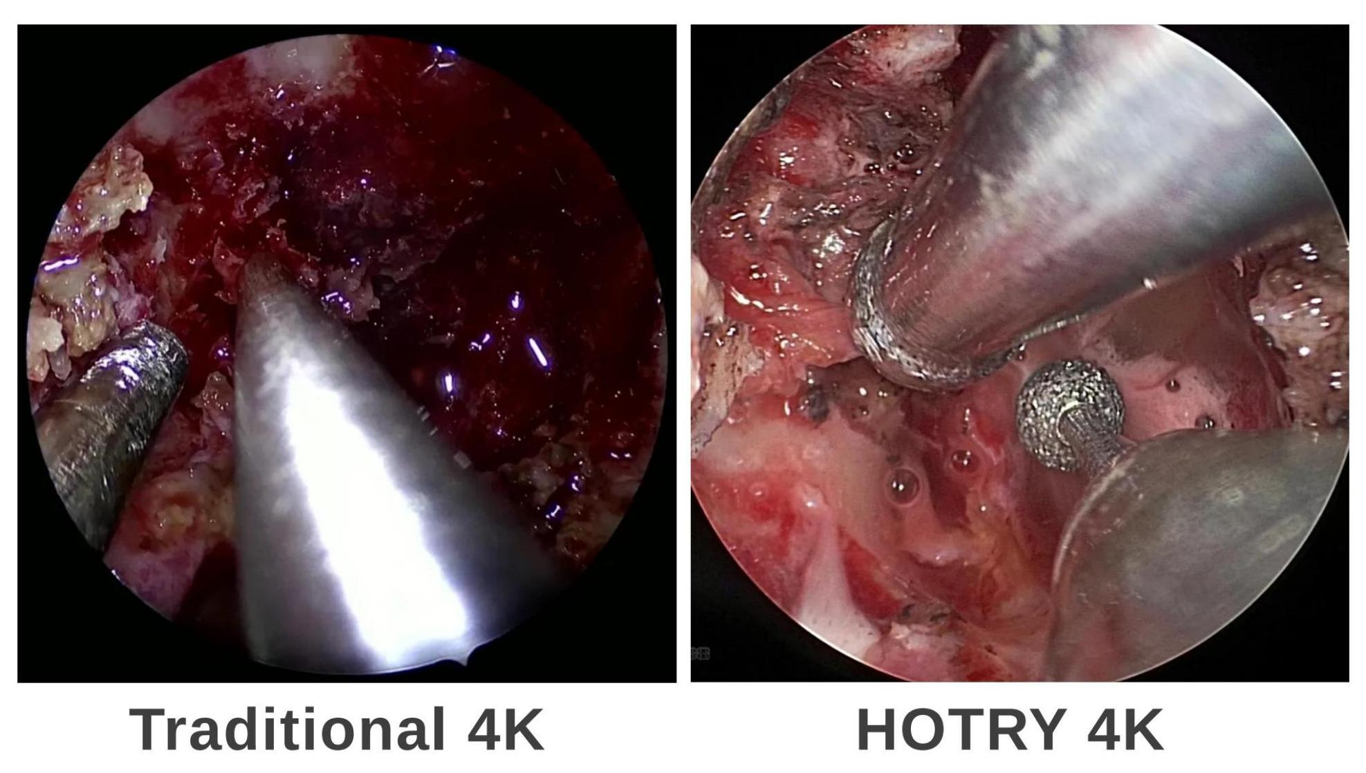 【Hotry 4k Neuroendoscopy System】 In neurosurgery, how should we choose an endoscopic device? Can endoscopic systems in other departments be competent for neurosurgery?