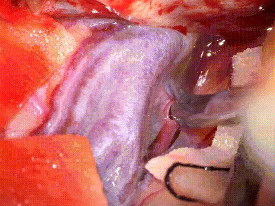 HOTRY Tumor fine operation set