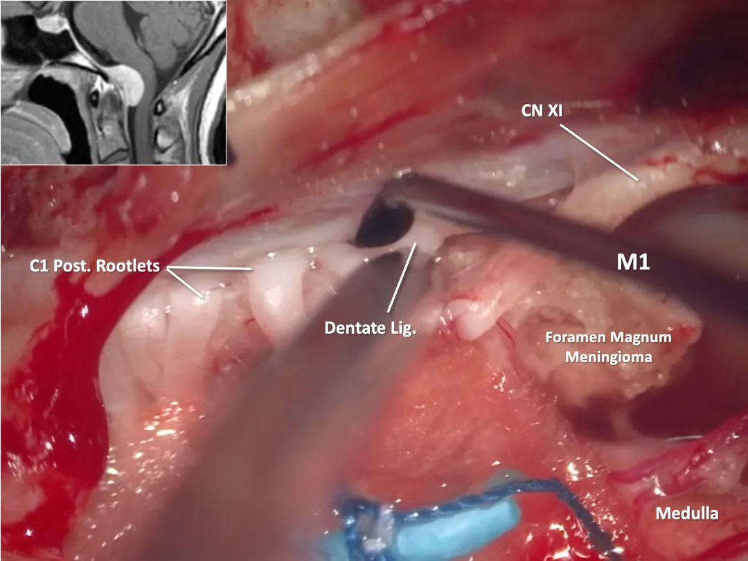 HOTRY Tumor fine operation set