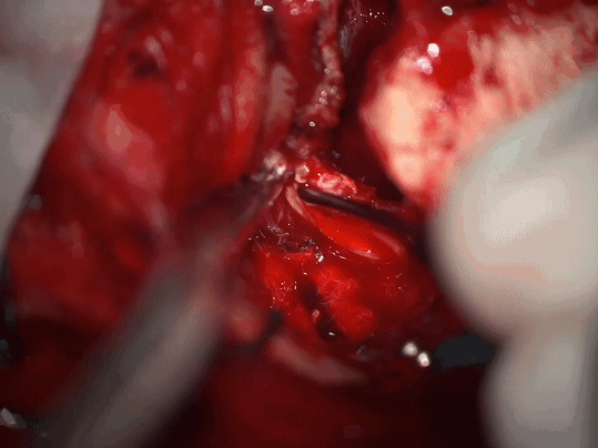 HOTRY Tumor fine operation set