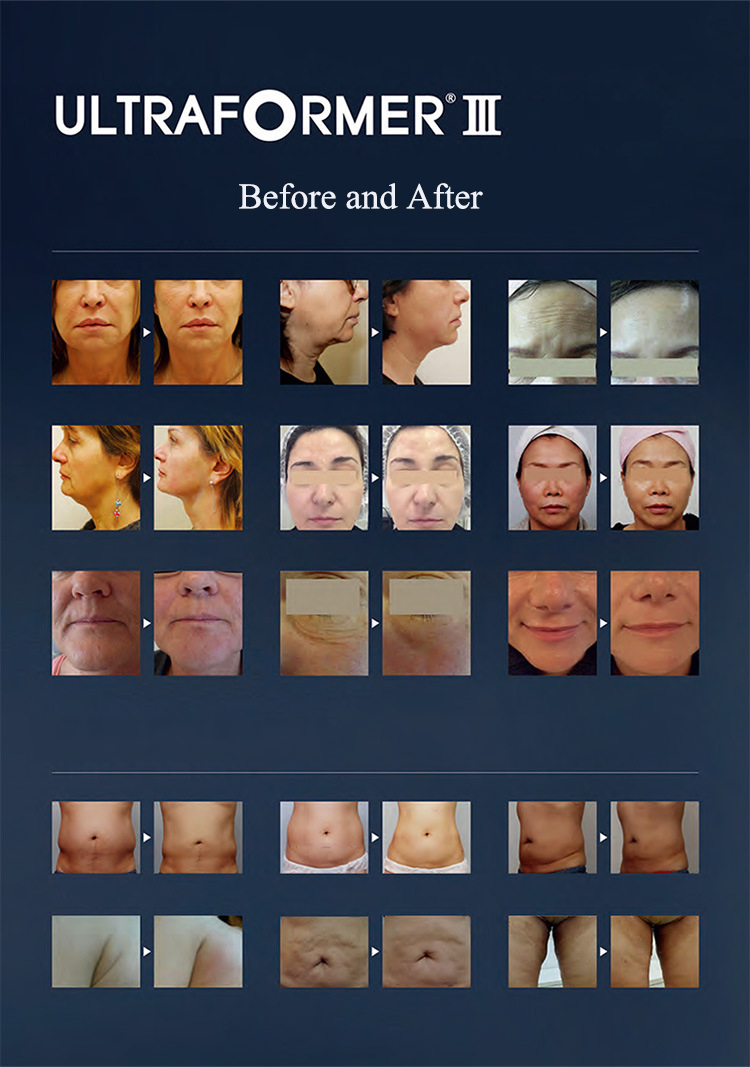 Portable 7D 20000 Times Painless HIFU 7D High Intensity Focused Ultrasound Face Lifting Winkle Removal Skin Rejuvenation Equipment Portable 7d HIFU machine for sale hifu machine,hifu machine price,7d hifu machine