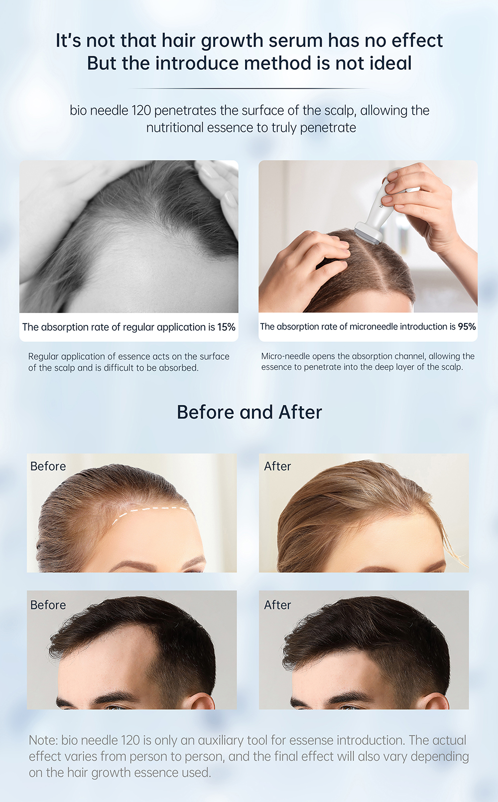 Derma Stamp 0-2 mm Adjust Needle Length derma Stamp Bio Needle 120Pin Microneedling Derma Roller for Beard Hair Growth Face Body Skincare Wholesale Derma Stamp Microneedles Derma Roller - Honkay 