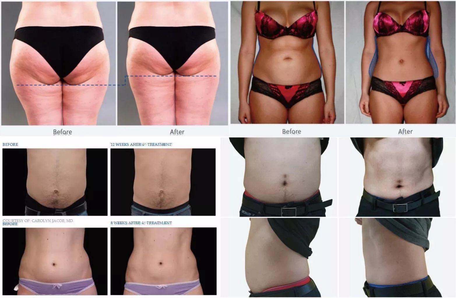 Portable EMSlim EMS Electromagnetic Body Slimming Fat Removal Build Muscle Machine Portable 4 Handles Emslim Body Slimming Machine - Honkay ems body sculpt machine,ems muscle building machine,emslim