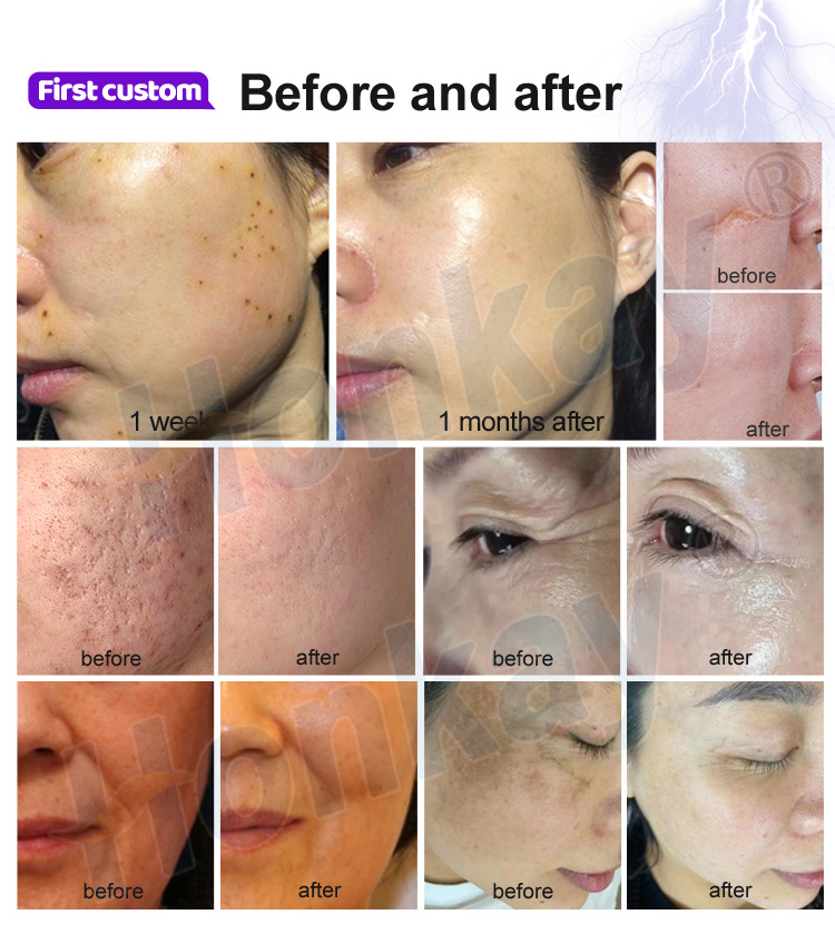 2025 Factory Price Wrinkle Removal Eye Lifting Facial Skin Care Eye Lifting Mole Removal 9 in 1 Hot and Cold Plasma Machine Cold Plasma Device: Brighten Skin & Remove Wrinkles Easily Cold Plasma Device,plasmamachineforwrinkles,plasmamachineforskin