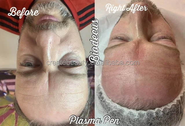 Newest Cold Plasma Technology 2 in 1 Acne Scar Removal Cold Plasma Ozone Generator Fractional Plasma Machine Ozone Plasma Device: Fight Fine Lines & Achieve Flawless Skin ozone plasma device,ozone cold plasma pen,ozone plasma facial