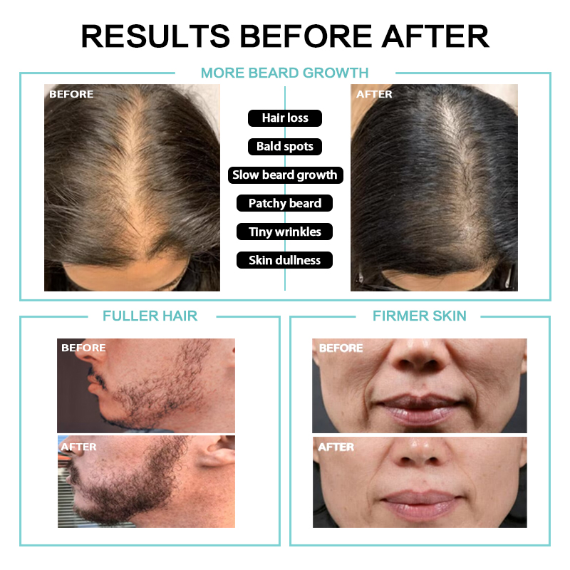 Hydra Microneedling Pen Red Blue Light Derma Pen M20 Hydra Microneedling Pen Red Blue Light Derma Pen M20 hydra pen,hydra micneedling pen,microneedling pen
