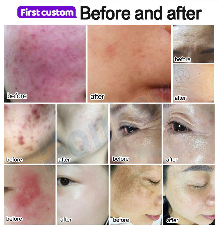 NEW Ozone Plasma Pen Face Cleaner Skin Care Beauty Device Purple Light Sterilization Acne Pimple Remove Plasma Pen Ozone Plasma Pen For Skin: Non-Invasive Anti-Aging Treatment Ozone Plasma Pen,Ozone Plasma Pen for sale,Ozone Plasma Pen cost