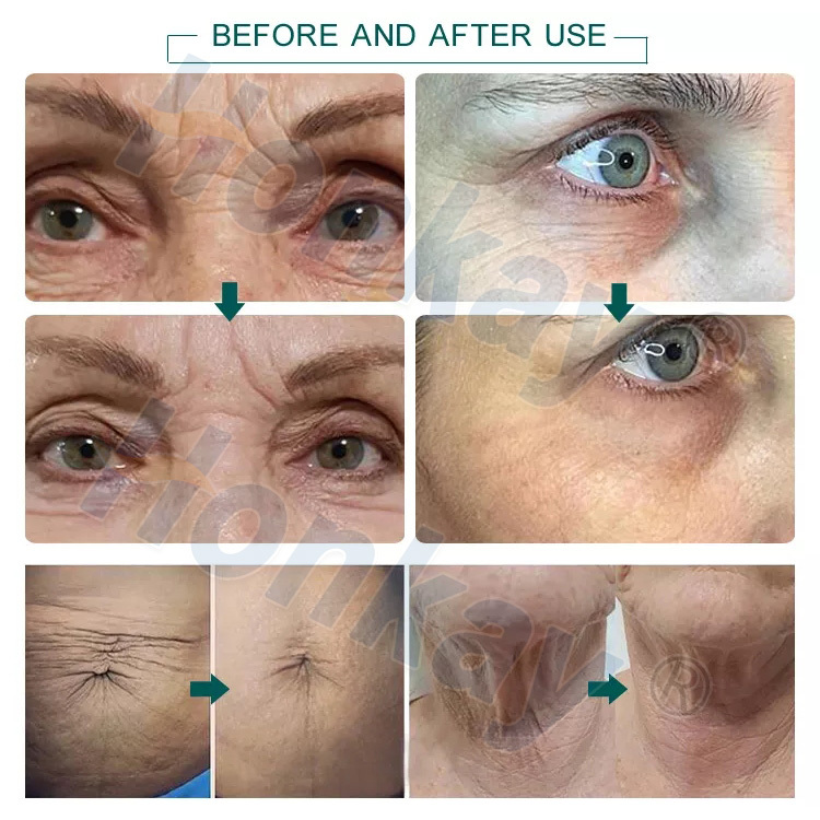 NEW Ozone Plasma Pen Face Cleaner Skin Care Beauty Device Purple Light Sterilization Acne Pimple Remove Plasma Pen Ozone Plasma Pen For Skin: Non-Invasive Anti-Aging Treatment Ozone Plasma Pen,Ozone Plasma Pen for sale,Ozone Plasma Pen cost