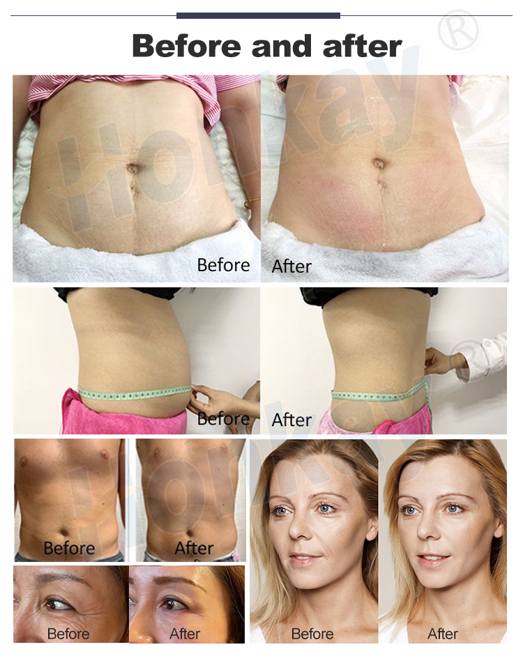 Newnet 448khz Cet Ret Tecar Therapy Equipment Diathermy Body Shaping Slimming Fat Reduction Massage Weight Loss Machine Newest 448Khz Cet Ret Tecar Therapy Physiotherpay Machine - Honkay Tecar therapy,tecarterapia,448kzh tecar therapy