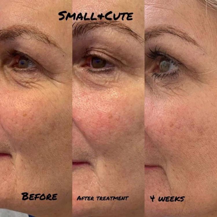 Facial Lifting Skin Firmness Anti-aging Wrinkle Eye Neck Forehead Wrinkles Removal Body Shaping Anti-aging Skin Care Machine Ice 7D Hifu Facial Machine Cost For Wrinkle-Free Skin Care best hifu machine professional,hifu facial machine for sale,Ice 7D Hifu Facial Machine Cost