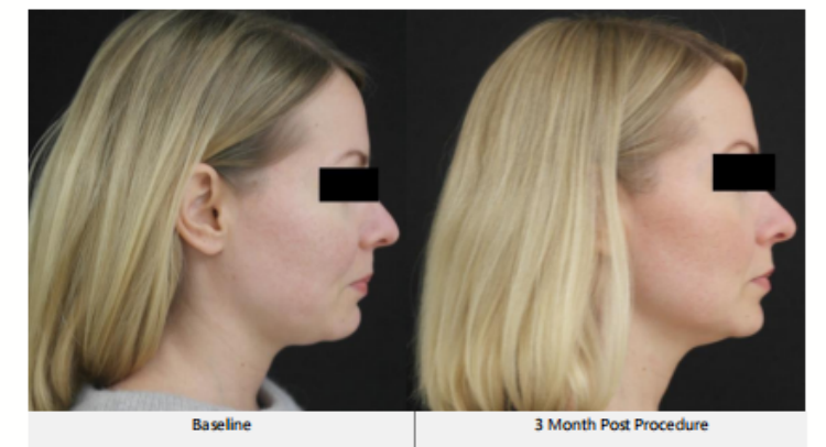 Facial Lifting Skin Firmness Anti-aging Wrinkle Eye Neck Forehead Wrinkles Removal Body Shaping Anti-aging Skin Care Machine Ice 7D Hifu Facial Machine Cost For Wrinkle-Free Skin Care best hifu machine professional,hifu facial machine for sale,Ice 7D Hifu Facial Machine Cost