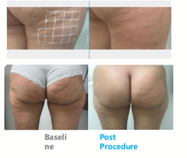 Facial Lifting Skin Firmness Anti-aging Wrinkle Eye Neck Forehead Wrinkles Removal Body Shaping Anti-aging Skin Care Machine Ice 7D Hifu Facial Machine Cost For Wrinkle-Free Skin Care best hifu machine professional,hifu facial machine for sale,Ice 7D Hifu Facial Machine Cost