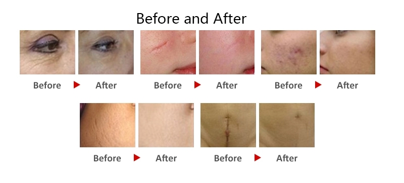 aser scar removal