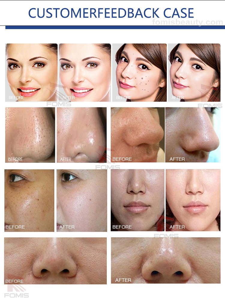 Deep cleansing hydro microdermabrasion facial oxygen jet peel machine