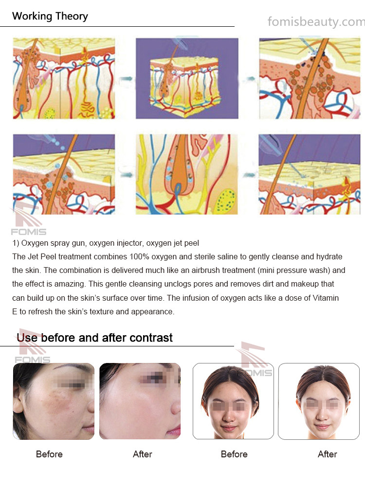 Diamond microdermabrasion for acne scars